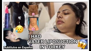 My Vaser Liposuction Journey  Maya Medical  Andrea Roman [upl. by Theadora]