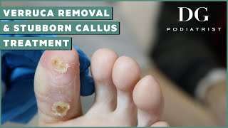 Verruca Mother Removal and Stubborn Callus Treatment  The Foot Scraper DG Podiatrist [upl. by Cynthea97]