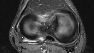 Fibular collateral ligament sprain and meniscus fascicle tear [upl. by Inavoig899]