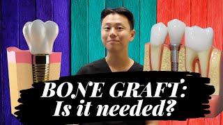 Dental Implant BONE GRAFTING  What to Expect Does It Hurt [upl. by Lemuela]