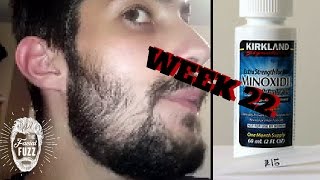 Minoxidil Beard Growth  3 Month Transformation  BEFORE and AFTER [upl. by Terrag863]