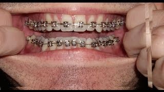 Orthodontic Treatment for Excessive Lip Support  Removing 4 Premolars [upl. by Ezirtaeb]