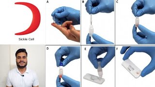 Sickle cell anemia  causessymptoms diagnosis test procedure treatment amp pathology sicklecell [upl. by Humphrey]