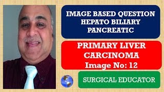 PRIMARY LIVER CARCINOMA  Hepato Biliary Pancreatic Image Based Question [upl. by Lavro48]