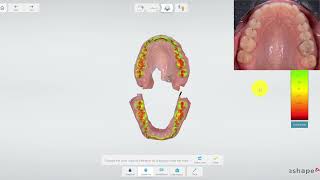 Bite Scan test TRIOS intraoral scanner [upl. by Hpeseoj799]