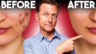 The FASTEST Way to Rid Acne  Dr Berg [upl. by Atekin]