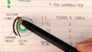 Gonioscopy Anterior chamber assessment [upl. by Dnalyk]