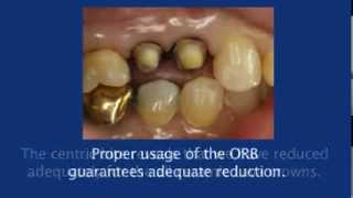 The Occlusal Reduction Bur  Demonstration of Use [upl. by Denys]