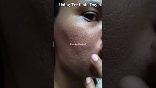 Using Tretinoin 0025 cream Day4 skincare viralvideo youtubeshorts shorts [upl. by Peppy]