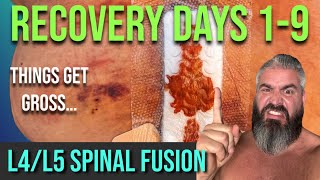 L4L5 Spinal Fusion And Decompression 9 Days After SurgeryThings Are Getting Gross [upl. by Duston780]