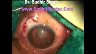 Intratunnel Phacofracture Technique Of MSICS In Postreior Polar Cataract By Dr Sudhir Singh [upl. by Sirac]