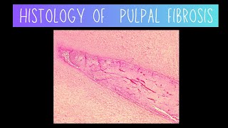 Histology of Pulpal Fibrosis  Dentistry [upl. by Livingstone]