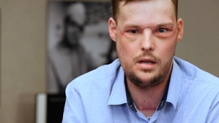 Face Transplant Links Men Touched by Tragedy [upl. by Aneelehs]