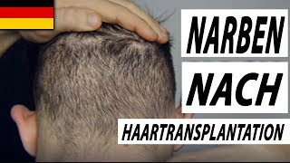 Haartransplantation Türkei Vorher Nachher Spenderbereich 110 MonateDonor Area Results [upl. by Aidnahs]