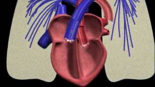 PFO closure animation [upl. by Grenville626]