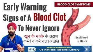 Never Ignore these Symptoms  Early Warning signs of a Blood Clot  DrEducation Hindi [upl. by Yerahcaz]