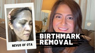 9th Session  Nevus of Ota Birthmark Removal using Laser  Qswitch NDYag [upl. by Aikahc]