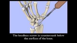 Scaphoid Fracture Screw Fixation [upl. by Hcurab617]