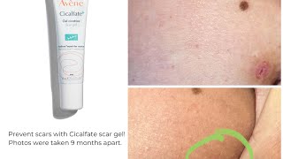 Avène Cicalfate Scar gel How to prevent scars treat them amp real before amp after photos included [upl. by Nevart]