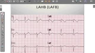 ECG 12 Lead Conduction System Abnormalities [upl. by Gearalt]