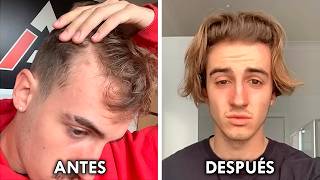 ¿El Secreto Para Recuperar El Pelo En 25 Meses [upl. by Nedmac157]