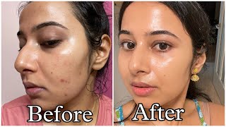 Simple Tretinoin Night Skincare Routine for Acne free Glowing Skin skincare skincareroutine [upl. by Macmullin]