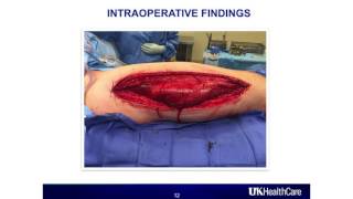 614 Thigh Compartment Syndrome ACSM Burnham 2016 Boston [upl. by Alonso]