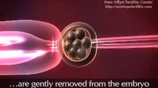 Preimplantation Genetic Diagnosis PGD [upl. by Nirehtac806]