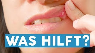 Tipps zur Mundpflege Das hilft gegen Aphthen [upl. by Klos]