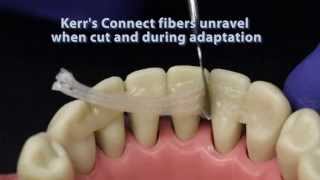 Ribbond compared to other dental fiber reinforcement materials [upl. by Browne]