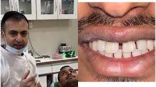 Mid line diastema  teeth gap closure दातों के बीच के गेप्स को भरना [upl. by Lilaj]