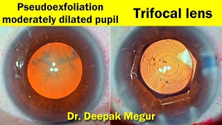 Trifocal lens in moderately dilated pupil with pseudoexfoliation  Dr Deepak Megur [upl. by Ayra565]