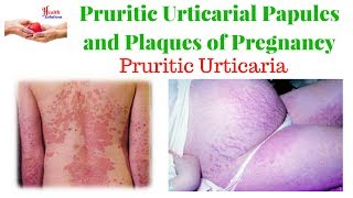 Pruritic Urticarial Papules and Plaques of Pregnancy  Pruritic Urticaria [upl. by Aelram143]