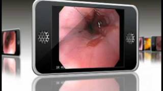 Barrett Esophagus Endoscopic Animation [upl. by Llerol]