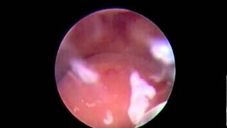 Polype utérin Confrontation Hystéroscopie echographie 4dManagment polyp hysteroscopy ultrasono 4d [upl. by Oiratnom]