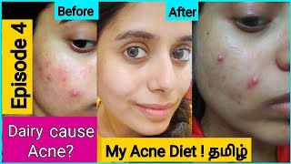 தமிழ் Foods To avoid for PIMPLE ACNE SKIN in Tamil  EP 4  Tips for Clear skin  MY ACNE DIET [upl. by Araldo552]