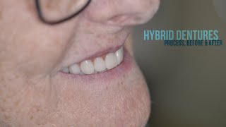 Hybrid DENTURES Process Before and After dentures smile dentistry painting teeth [upl. by Nilrac]