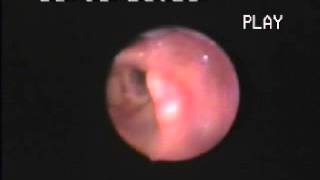 Video 4  Laryngeal abductor reflex [upl. by Naus]