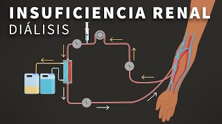 Insuficiencia Renal Terminal y Dialisis [upl. by Thema]