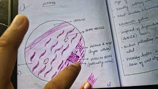 schwannoma histopathology gross and microscopic features [upl. by Avad624]