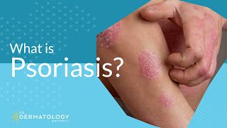 What Is Psoriasis [upl. by Karly]