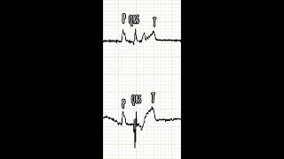 Orthodromic atrioventricular reciprocating tachycardia in a Labrador affected by tricuspid dysplasia [upl. by Homere885]