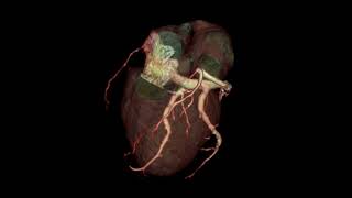 CORONARY VENOGRAM [upl. by Dwayne]