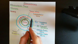 Atherosclerosis Part 1 [upl. by Ossy]