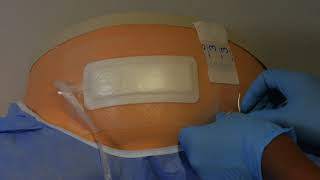 Application of Avelle NPWT System following a caesarean section [upl. by Neomah698]