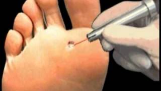 Plantar Wart Laser Treatment  Institute Beaute New York [upl. by Tenom335]