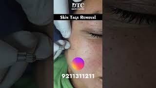 Skin Tags Removal Treatment Dr Rohit Goel [upl. by Ximenez549]