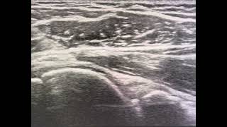 Ultrasound guided glenohumeral joint needle placement posterior approach [upl. by Ntsuj]