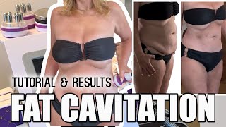 Fat Cavitation  Does it Work My Results cavitation fatloss [upl. by Ahcilef]