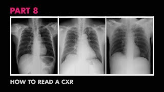 Diaphragms and Pleural Effusion  How to Read a Chest XRay Part 8  MEDZCOOL [upl. by Anierdna]